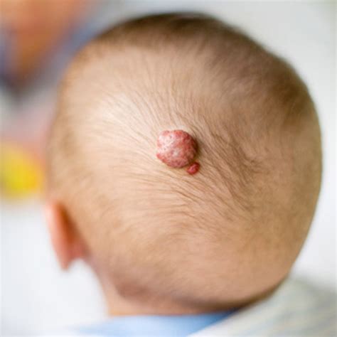 Common Infant Skin Conditions Real Things Happening Quotes And Others