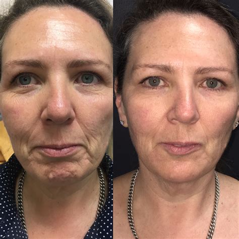 Non Surgical Jowl Lift Thread Lift Hifu Injectables And Fillers For Jowl