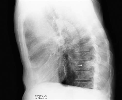 Lateral Chest Radiograph A Systematic Approach Semantic Scholar