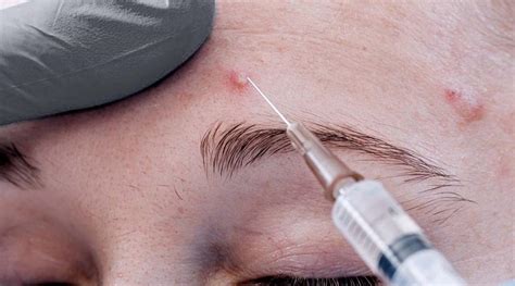 Acne And Scar Treatment Intralesion Cortisone Injection Premier Clinic