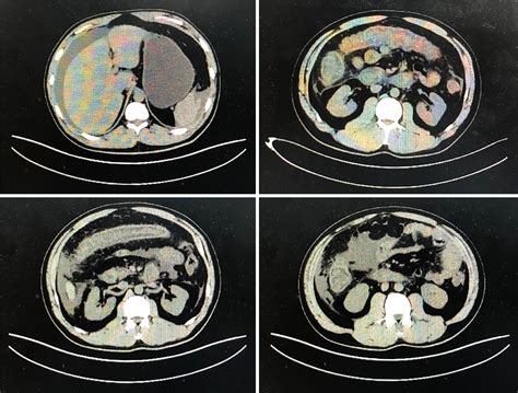 Figure 1 From Eosinophilic Gastroenteritis With Abdominal Pain And