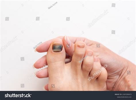 Subungual Hematoma Present Under Toenail Hallux Stock Photo 2187295673