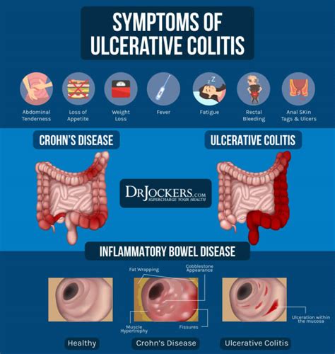 Ulcerative Colitis Causes Symptoms And Support Strategies