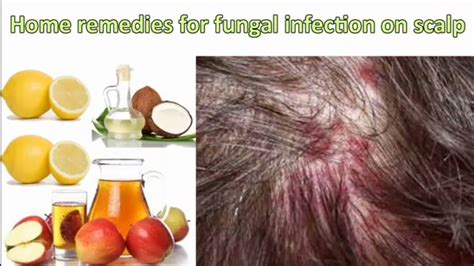 Details 80 Fungal Infection On Hair Scalp Best In Eteachers