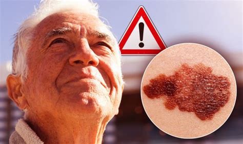 Skin Cancer Symptoms Signs Of Melanoma In The Hot Weather And Uk