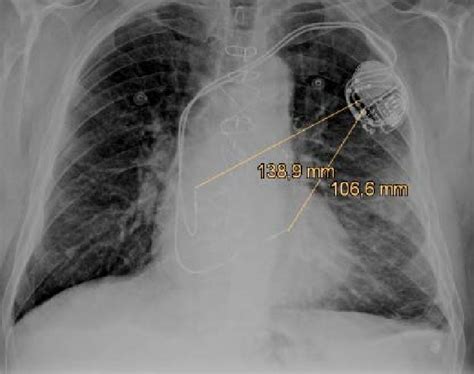 The Anteroposterior X Ray Projection Of The Dual Chamber Pacemaker With