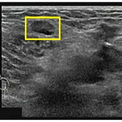 Ultrasound Scan Of The Right Groin Displaying An Enlarged Lymph Node