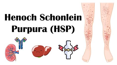 Henoch Schoenlein Purpura Hsp Causes Pathophysiology Diagnosis