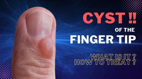 Finger Mucous Cyst Learn To Treat In 3 Minutes Youtube