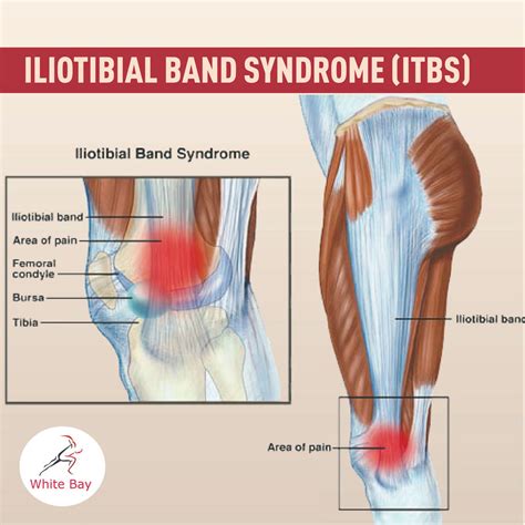 Iliotibial Band Syndrome Knee