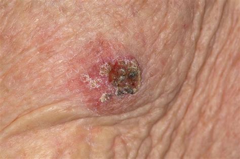 Squamous Cell Cancer On The Arm Photograph By Dr P Marazziscience