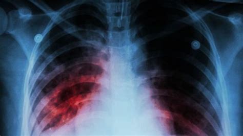 Medicina Digital Fibrosis Pulmonar Idiopática una rara enfermedad