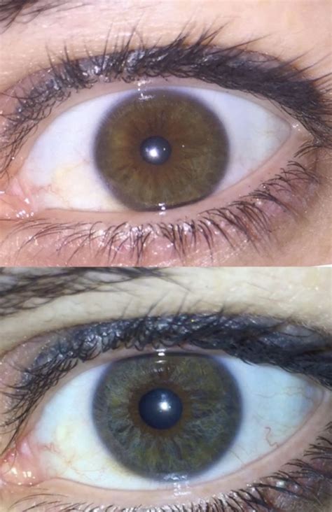 Change Your Eye Color Permanently By Operation Changingeyecolor Eye Color Change Permanently
