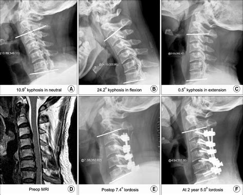 Figure From The Surgical Treatment Of The Cervical Myelopathy With Laminectomy And Posterior