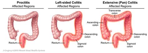 JCM Free Full Text Ulcerative Colitis Current And Emerging