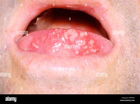 A Picture Of An Acute Vesicular Eruption On The Tongue Caused By