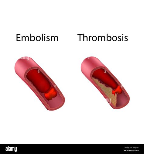 Embolism And Thrombosis Comparison Illustration Stock Photo Alamy