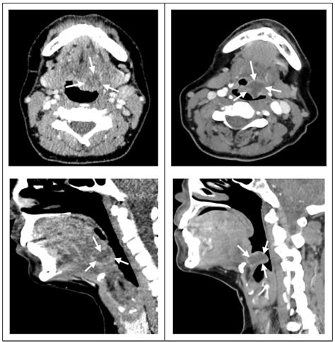 Contrast Enhanced Neck Computed Tomography Scan Left Case 1 Left