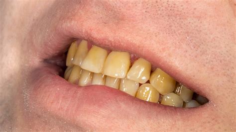 Top Teeth Discoloration Risk Factors Od
