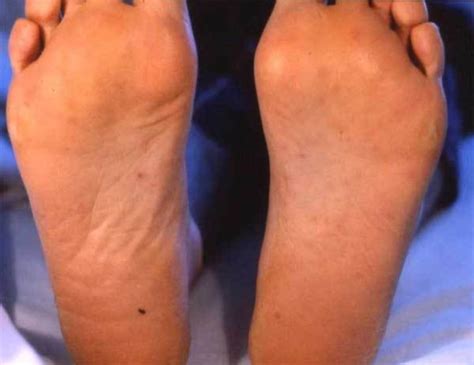 Maculopapular Rash On The Soles Of The Patients Feet Open I