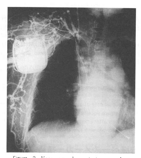 Figure From A Case Of Massive Upper Extremity Edema After Arterio Venous Fistula Formation For