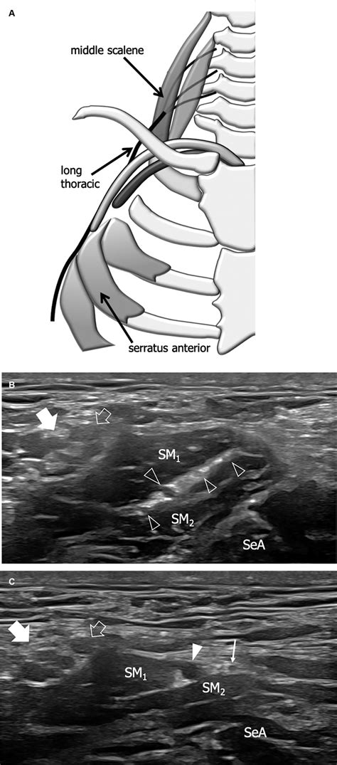 Long Thoracic Nerve A Schematic Drawing Illustrates The Normal