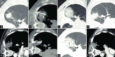 A 45 Year Old Woman Who Had An Incidental Lung Mass Found On Ct For