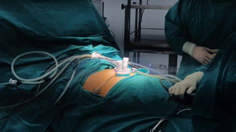 Single Incision Laparoscopic Surgery Sils