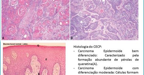 Patologia Oral Carcinoma Epidermoide