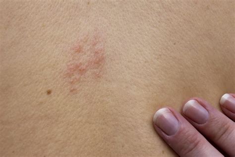 Shingles Pain Care Services In Salisbury And Rowan County Piedmont
