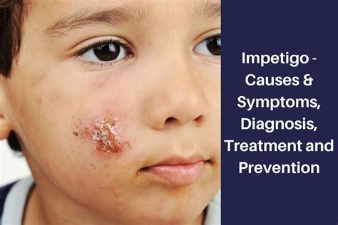 Impetigo Causes And Symptoms Diagnosis Treatment And Prevention
