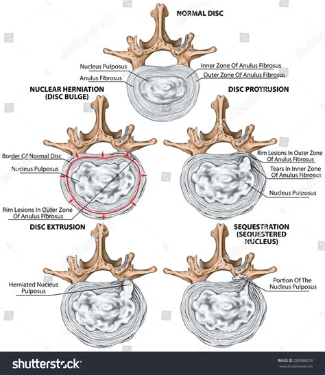 Types Of Disk Herniation