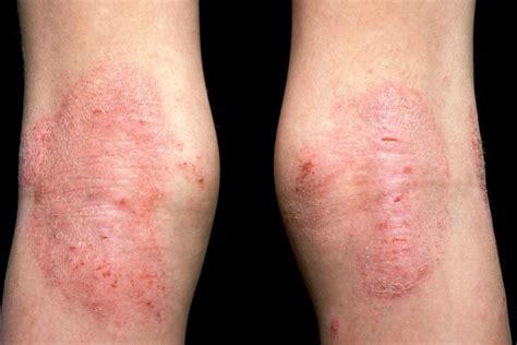 Eczema Atopic Nidirect