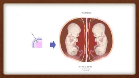 obstetricia embarazo gemelar