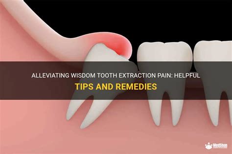Alleviating Wisdom Tooth Extraction Pain Helpful Tips And Remedies