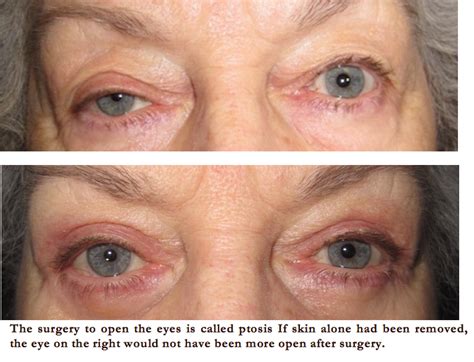 Eyelid Surgeon In Denver What Cosmetic Eyelid Surgery Alone Will Not