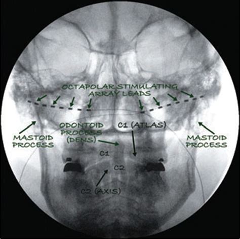 Occipital Nerve Stimulation Anesthesia Key