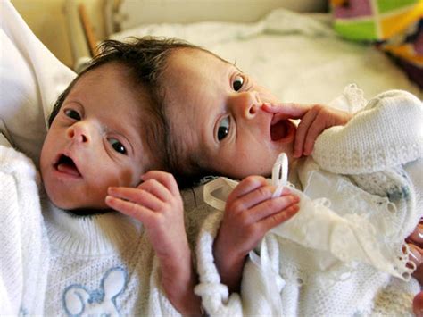 Conjoined Twins Conjoined Twins Warning Graphic Images Pictures Cbs News