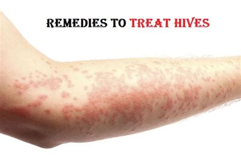 How To Treat Hives