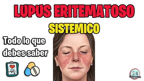 Lupus Eritematoso Sistemico Sintomas Tratamiento Youtube