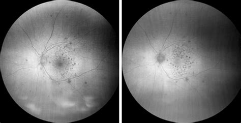 Fundus Autofluorescence Of The Same Eye Obtained With Zeiss Clarus 500