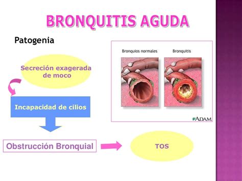 Bronquitis Aguda Imagenes