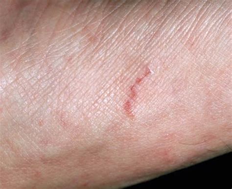 Scabies Signs Symptoms Otc Treatment And Home Remedies