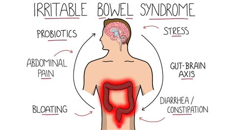 Irritable Bowel Syndrome Ibs Including Symptoms Criteria And Treatment Youtube