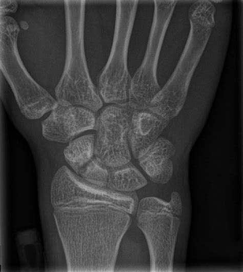 Radiograph Of The Left Wrist Shows Stress Fracture Of The Left Scaphoid