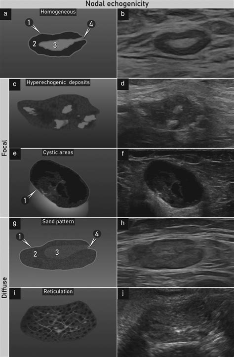 Terms Definitions And Measurements To Describe Sonographic Features Of