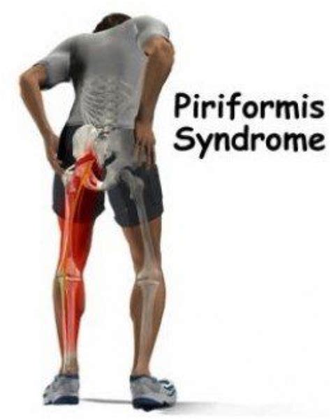 I Will Explain The Importance Of The Piriformis Muscle Common Places Of Trigger Points Fascial