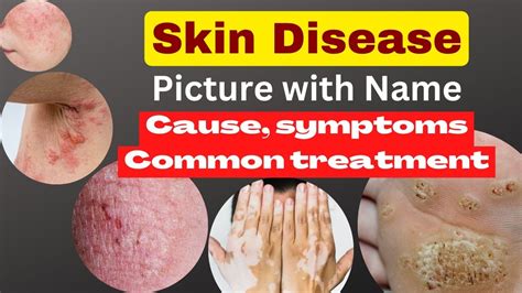 Skin Disease Picture With Name Skin Problem With Namecause Symptoms