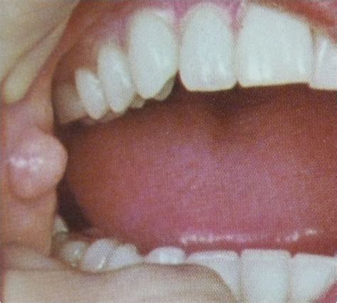 Oral Pathology Fibroma