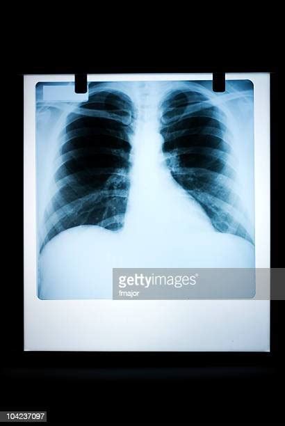 Normal Lung X Ray Photos And Premium High Res Pictures Getty Images